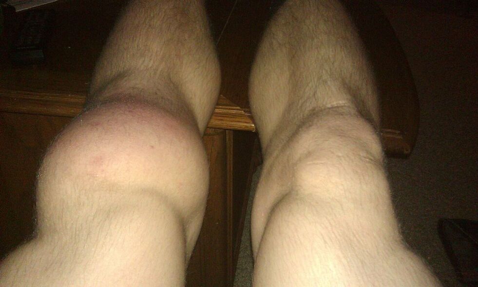 ceļa pirms ārstēšanas ar Osteflex
